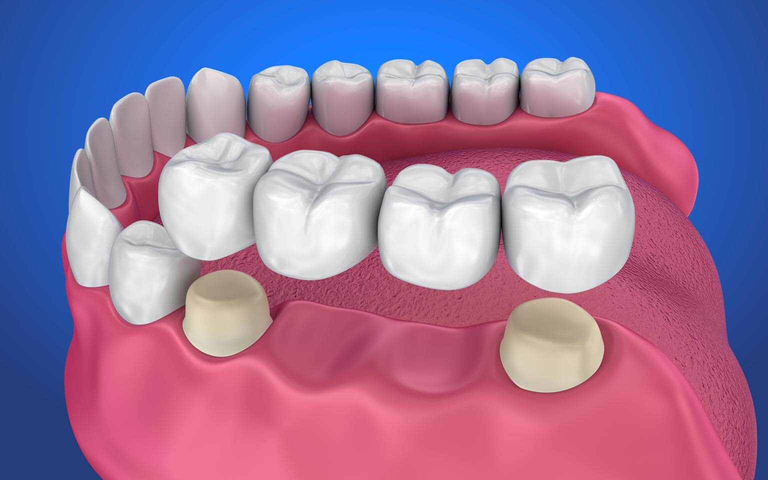 Dental bridge Dental bridge
