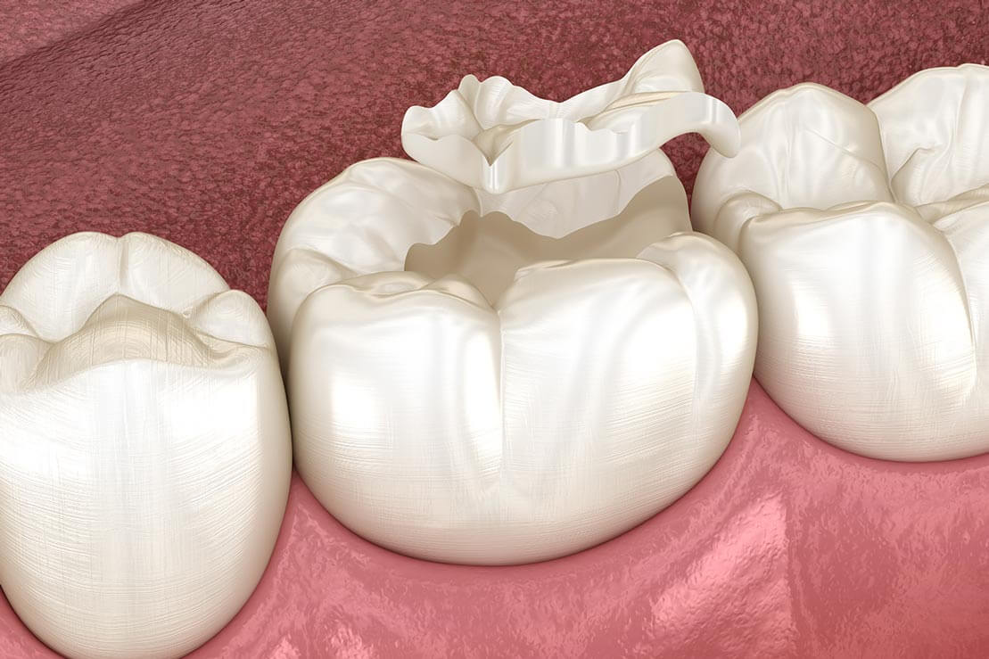 Dental Inlays Dental Inlays