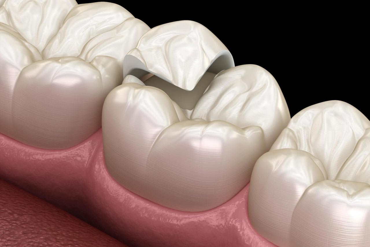 Dental Onlay