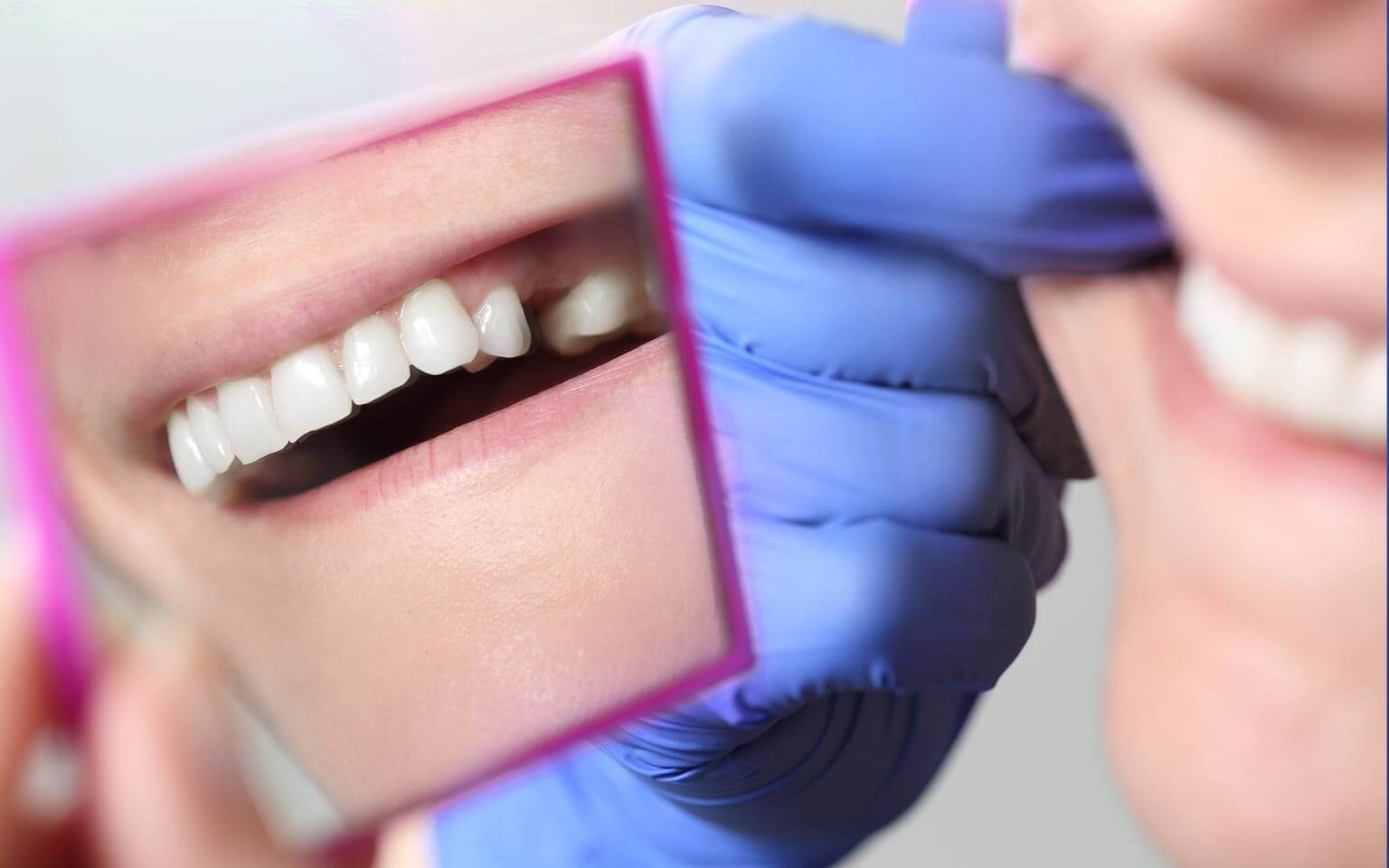 Dental Bridges Dental Bridges