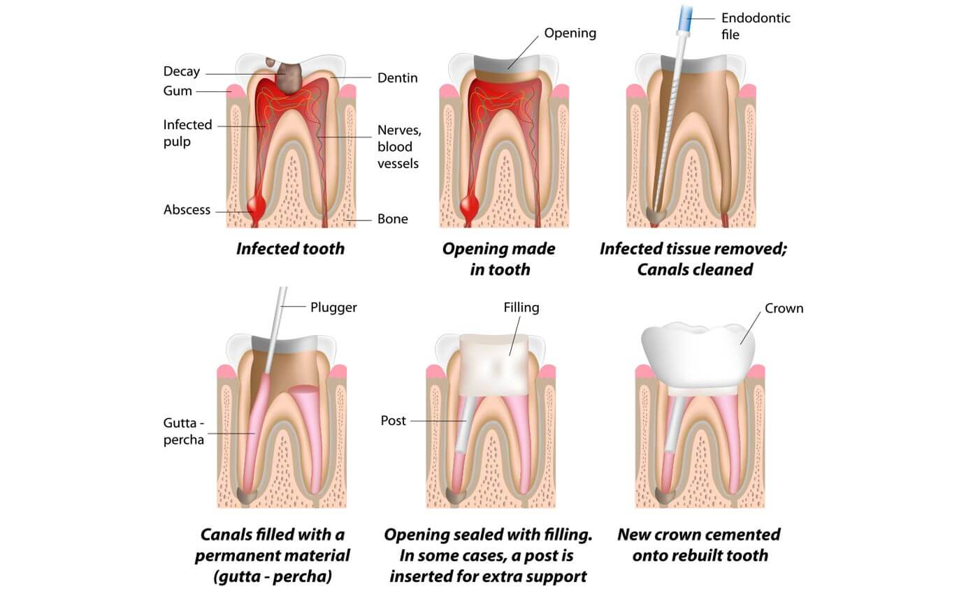 Root Canal Treatment