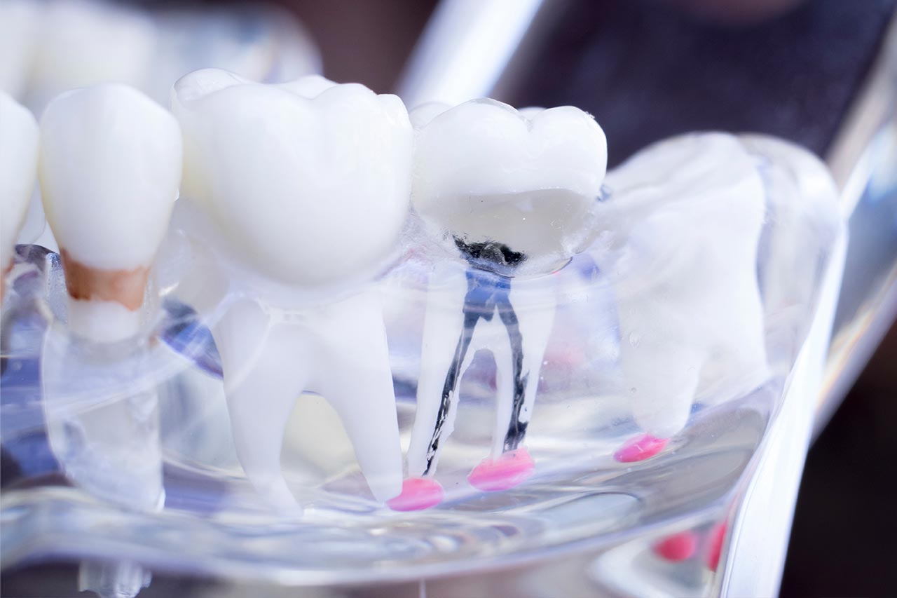 Root canal treatment Root canal treatment