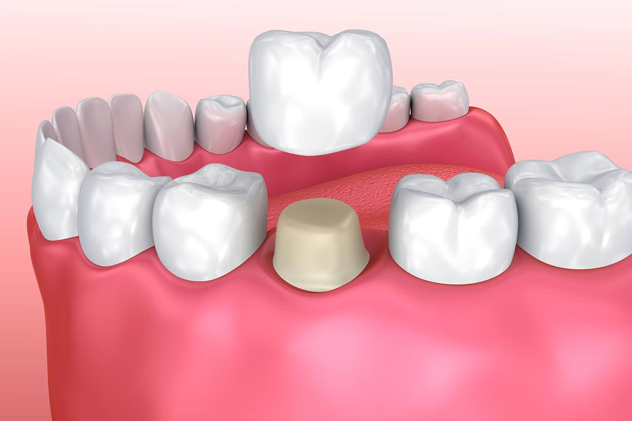 Depiction of a dental crown