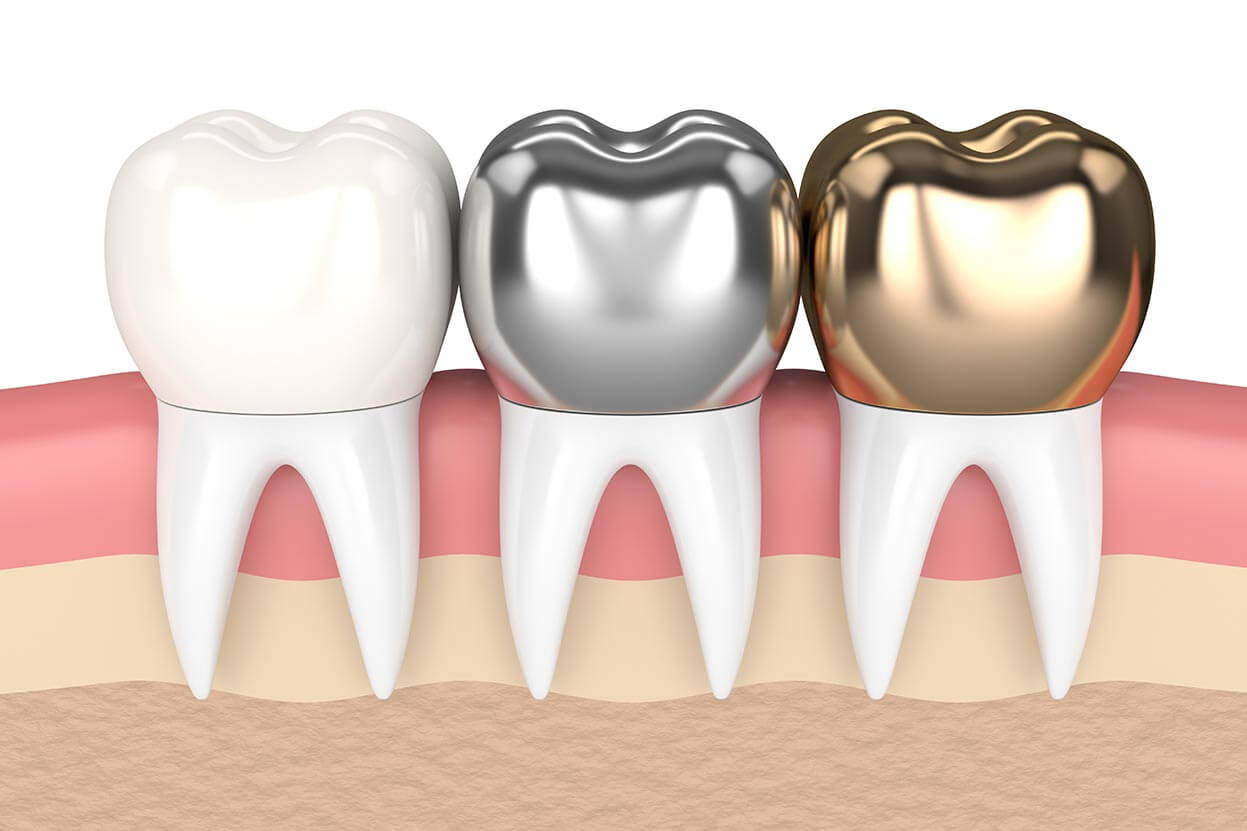 Dental Crown Diagram