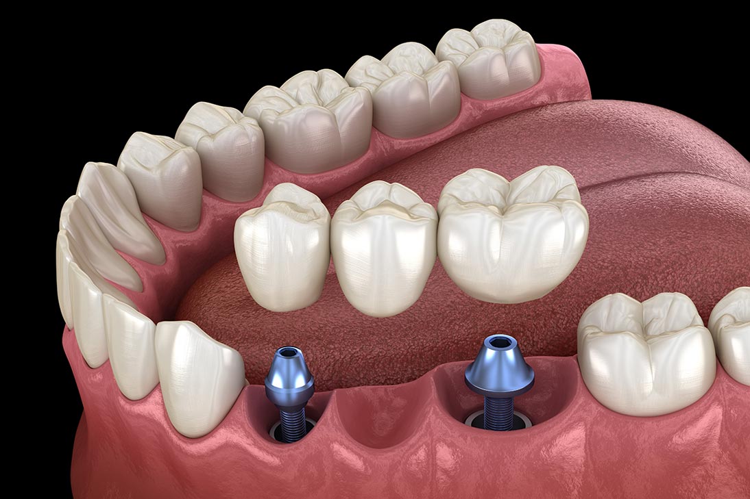 Dental Implants - Bridge