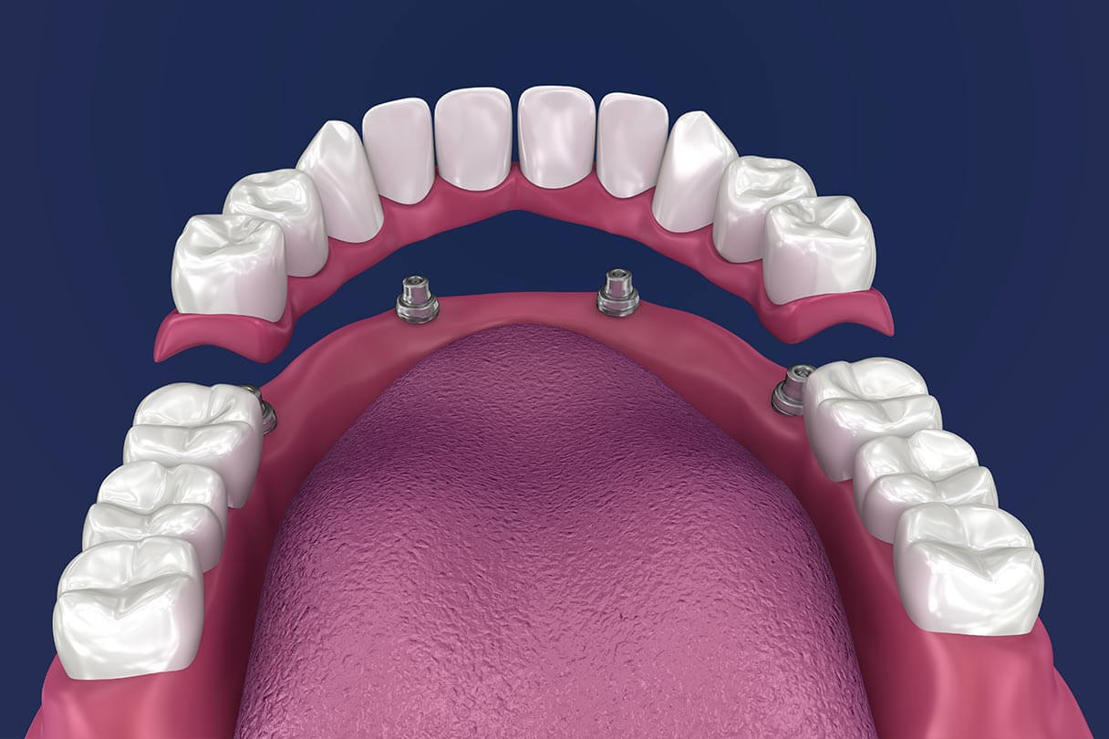 Dental implant dentures