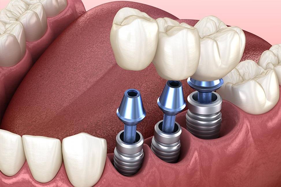 Multiple dental implants