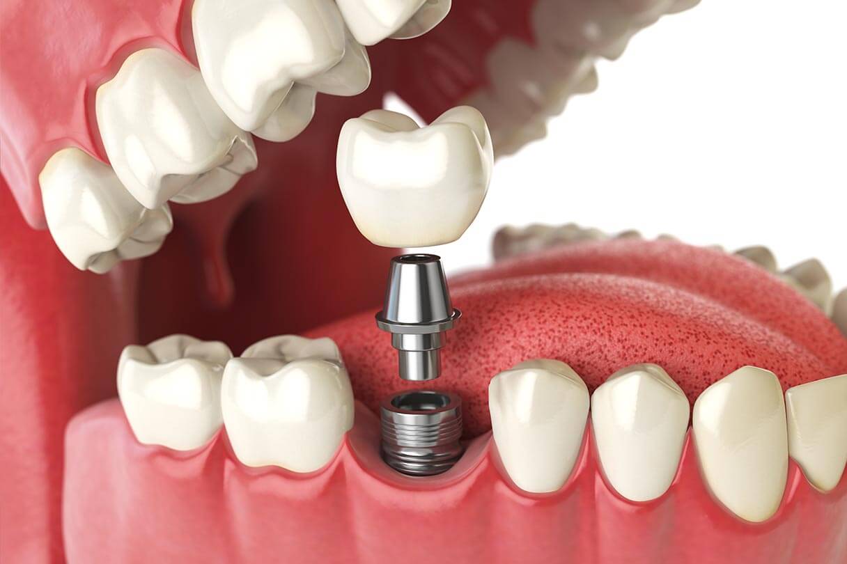 Single dental implant