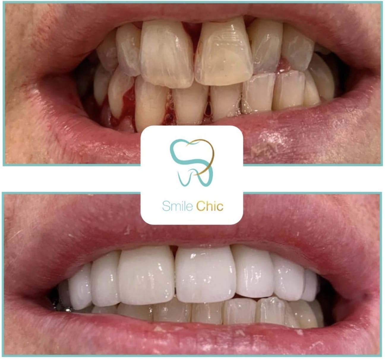 composite-4 composite bonding