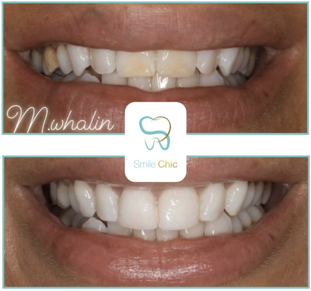 composite-5 composite bonding
