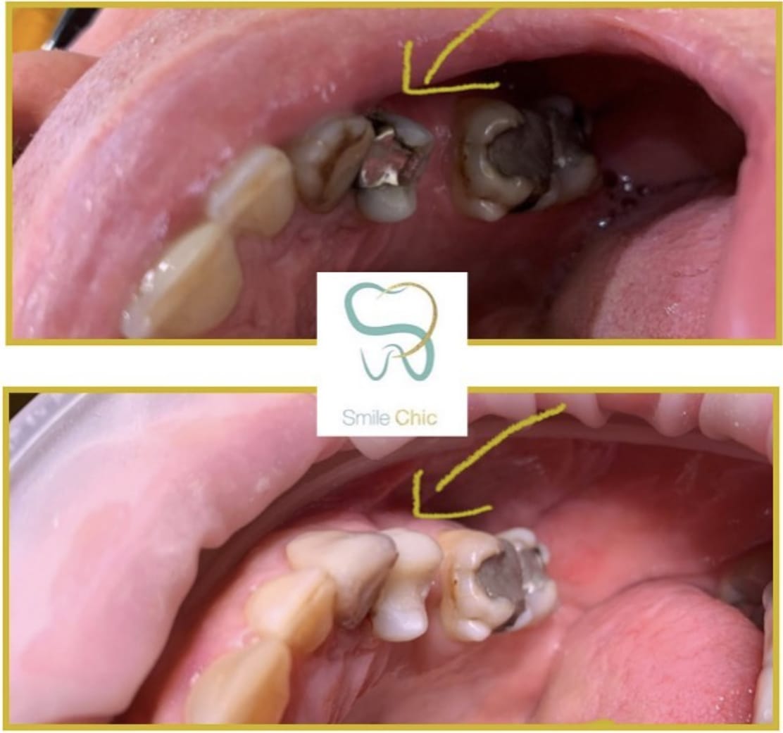 dental fillings