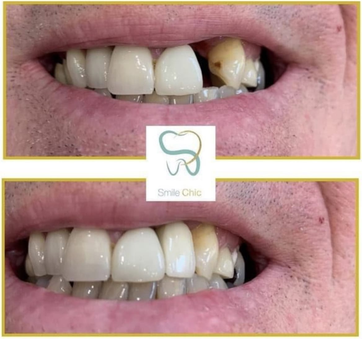 dental-implants dental implants