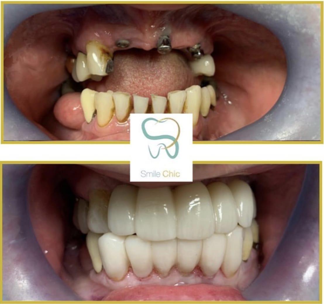 dental implants