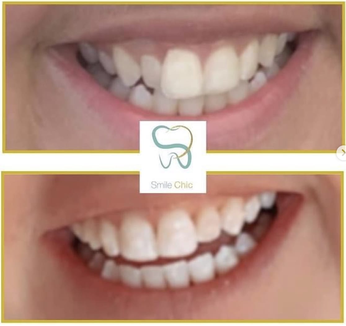 teeth-straight-2 teeth straightening